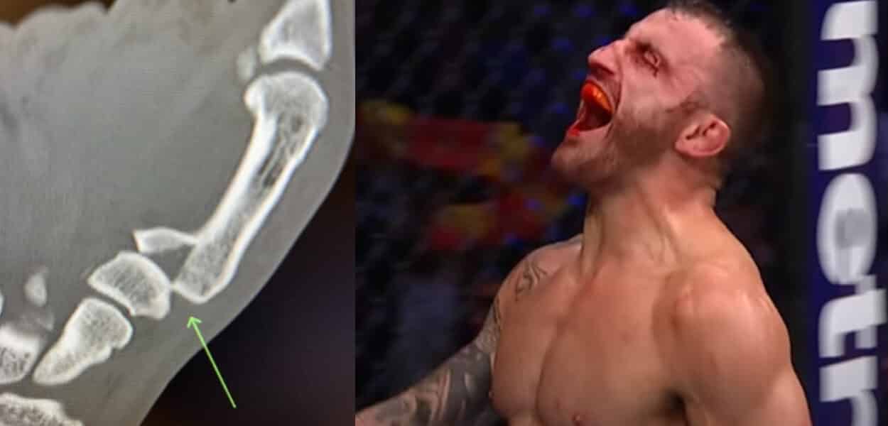 Volkanovski-Blessure