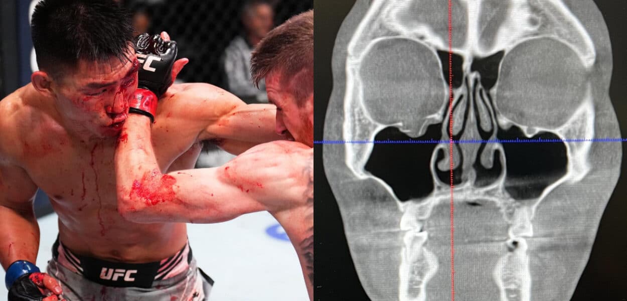 song-yadong-blessure
